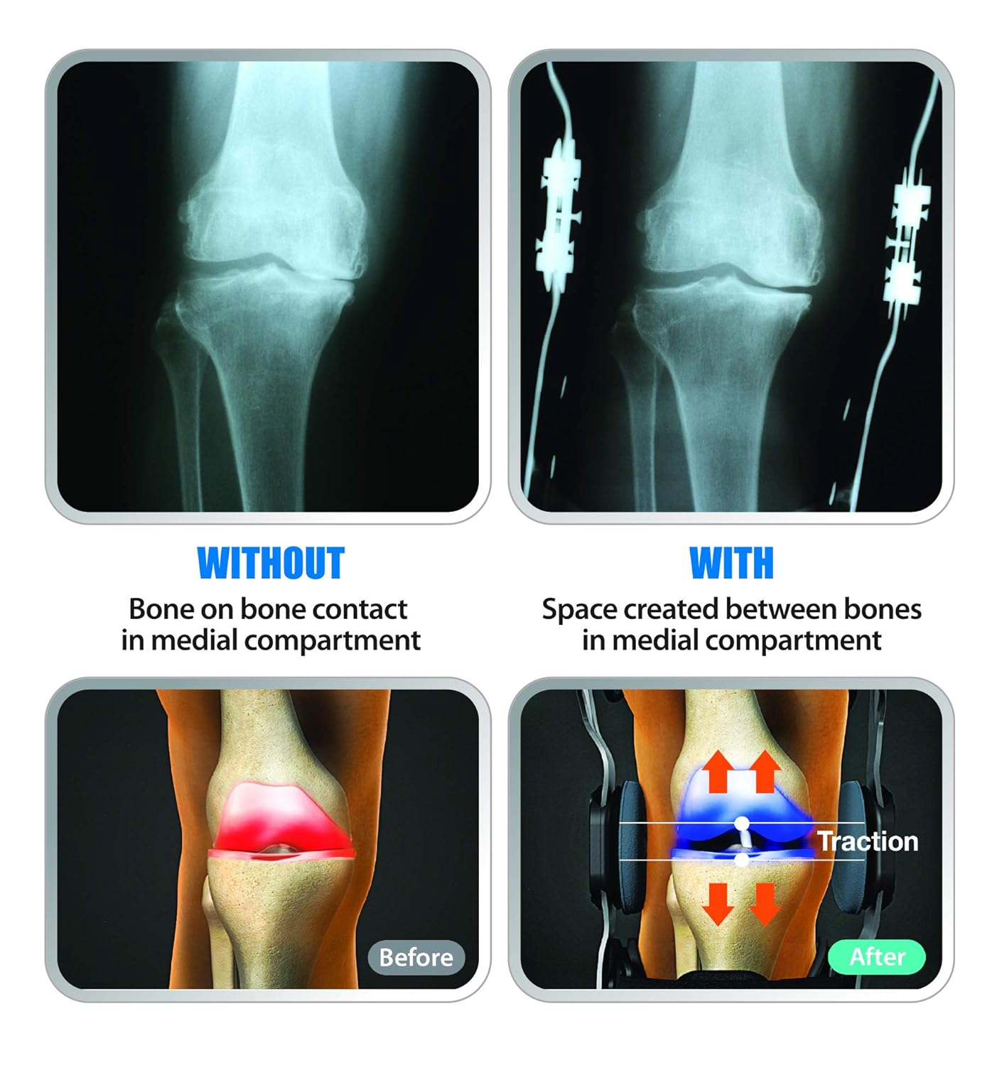 OA Pro Decompression Knee Brace – Unloader Brace for Discomfort from Degeneration, Meniscus Tear, Arthritis, Bone-on-Bone Pressure